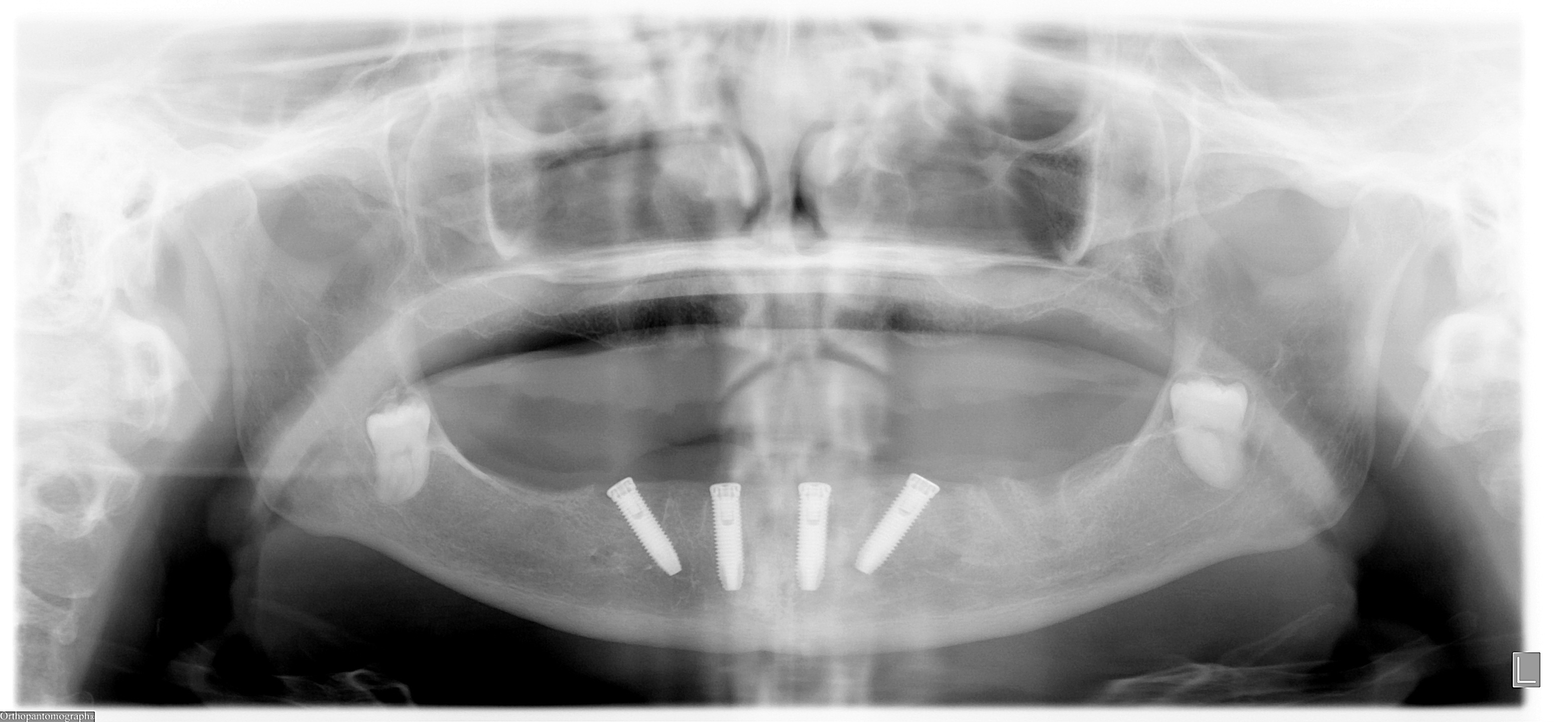 Saskatoon, SK Implantologist, Charles Britton, DMD offers the All On Four, Immediate Function Dental Implants